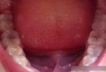 Ung thư ruột kết có thể xuất phát từ... miệng